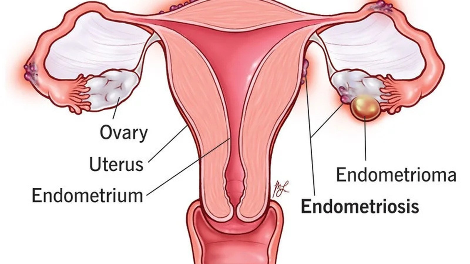 Endometriosis & Fertility image