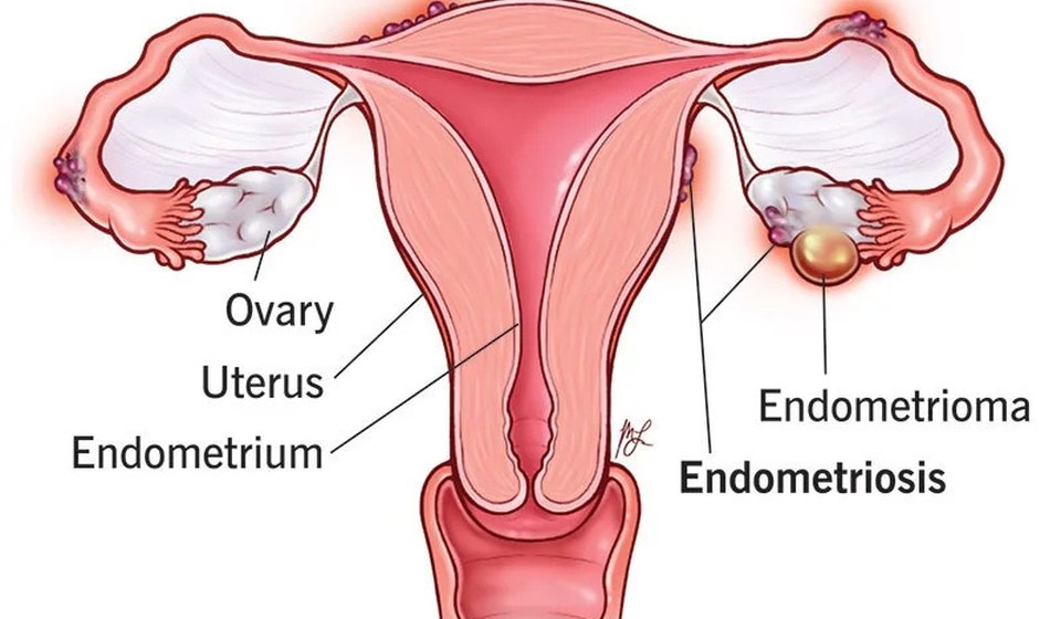 Endometriosis & Fertility at MOMZY Women and Fertility Centre