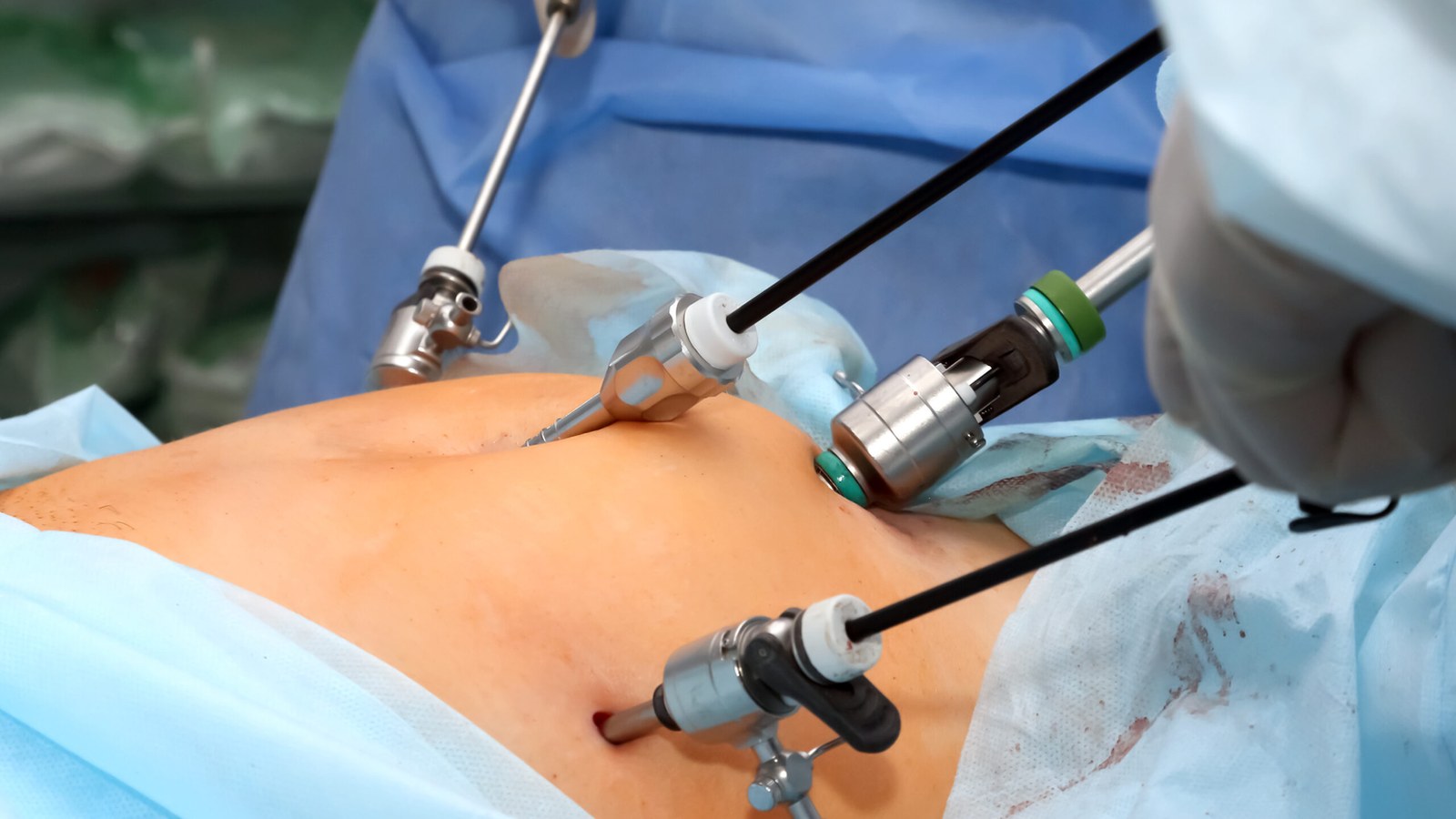 Laparoscopy for Fertility image