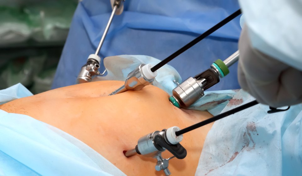 Laparoscopy for Fertility at MOMZY Women and Fertility Centre