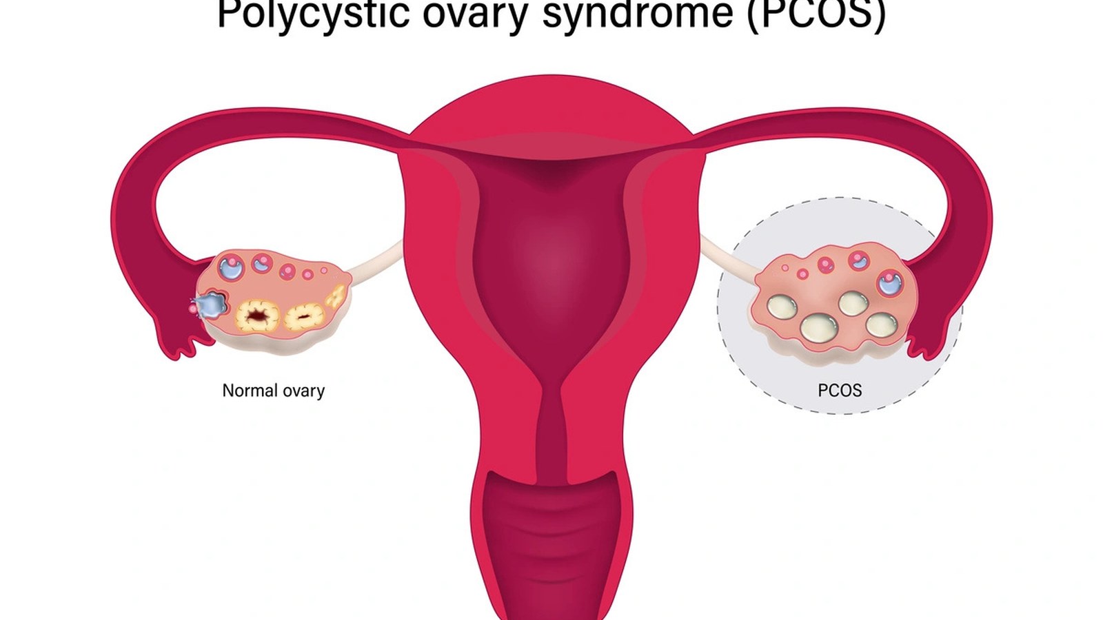 PCOS Fertility Care image