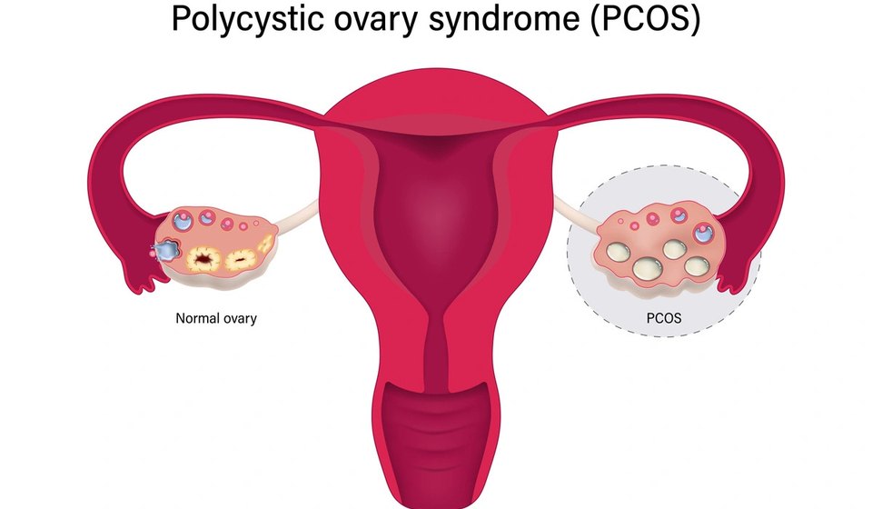 PCOS Fertility Care at MOMZY Women and Fertility Centre