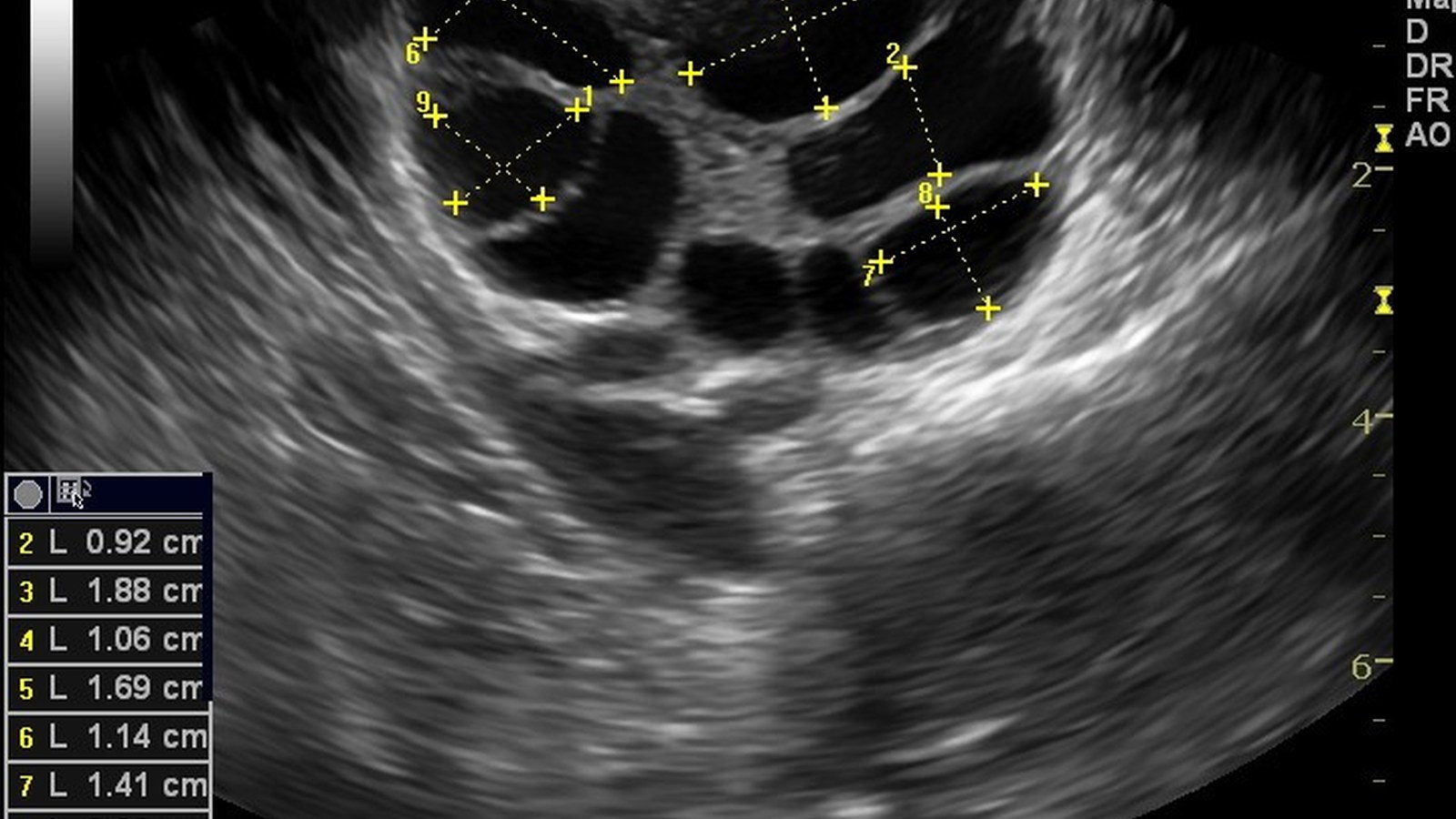 Sonography & Follicular Monitoring image