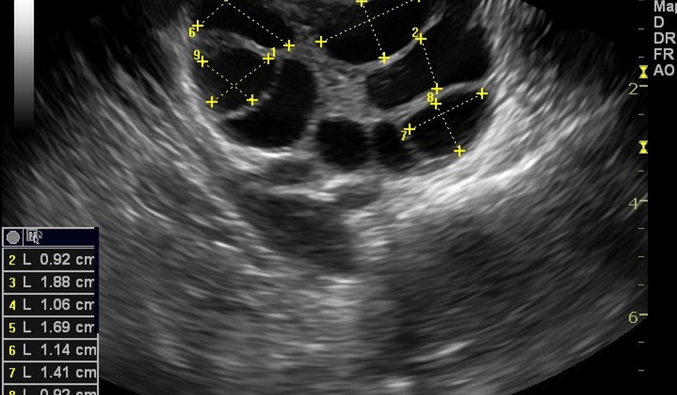 Sonography & Follicular Monitoring at MOMZY Women and Fertility Centre