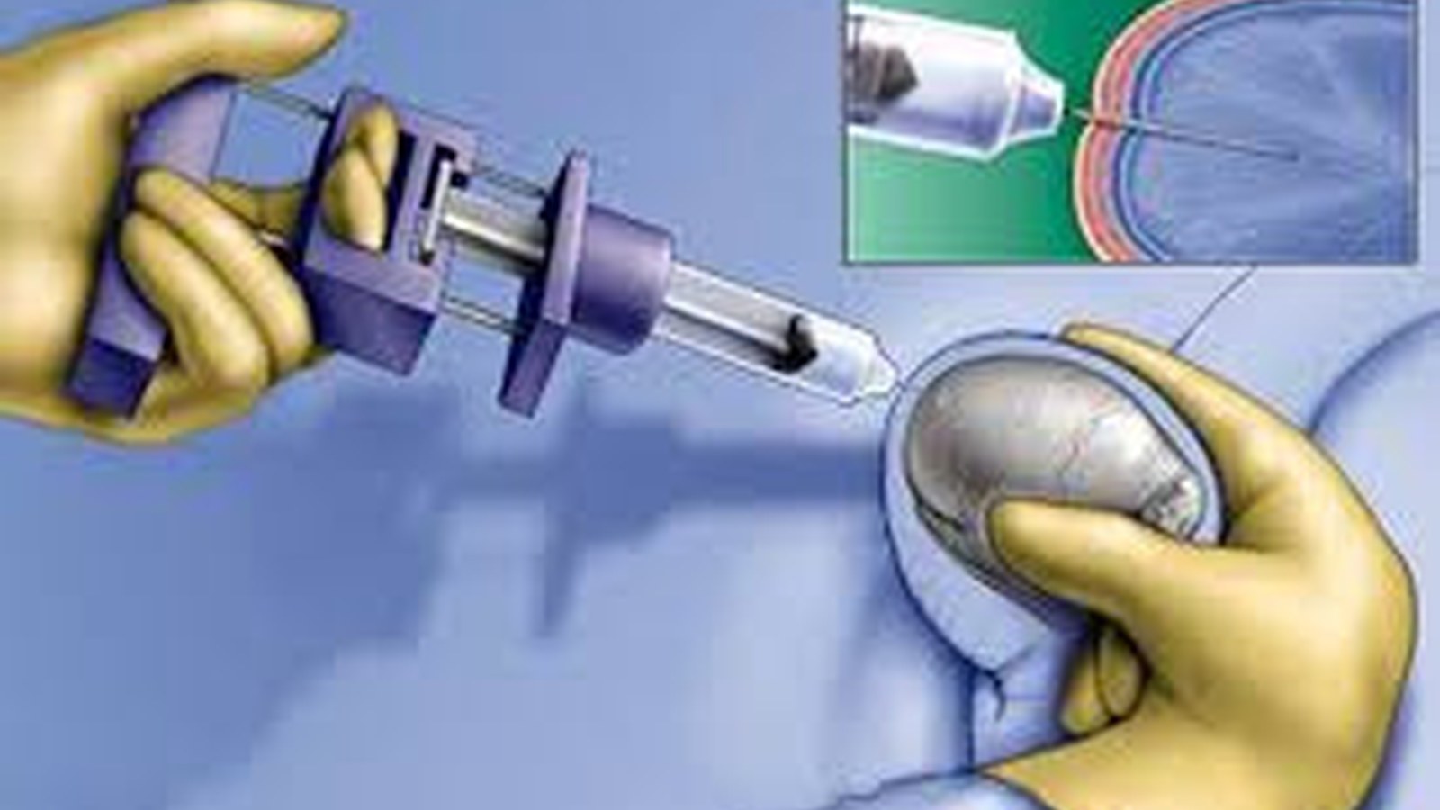 Surgical Sperm Retrieval image