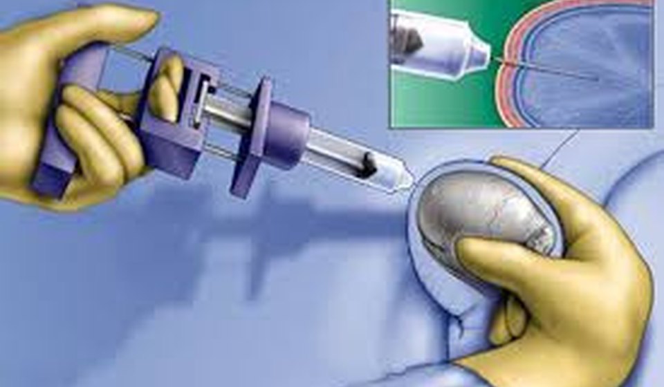 Surgical Sperm Retrieval at MOMZY Women and Fertility Centre