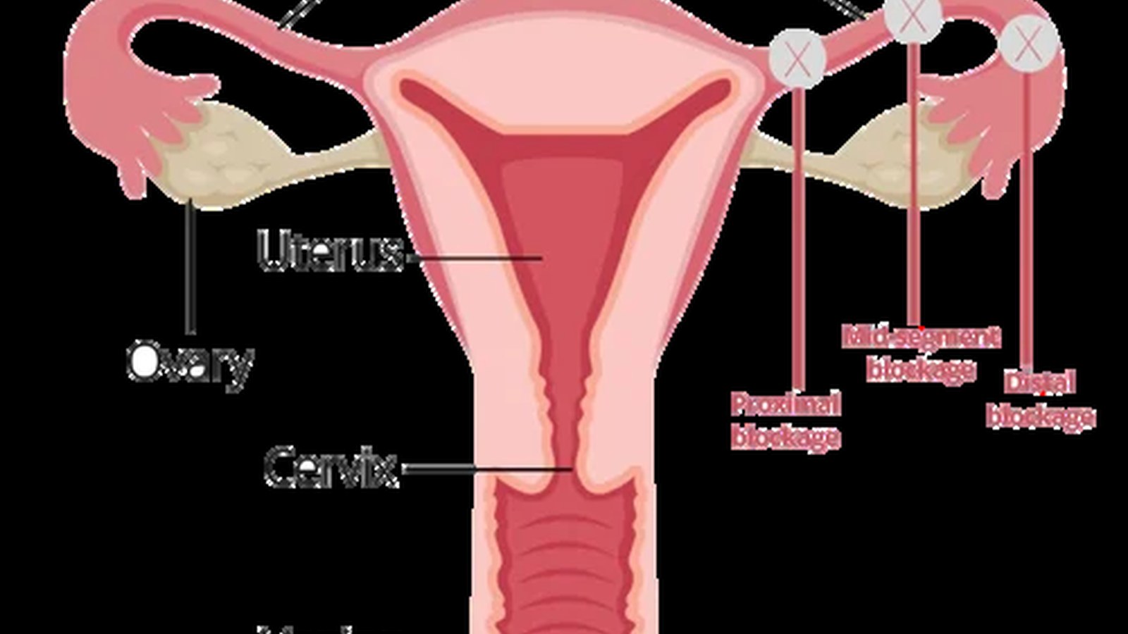 Tubal Factor Infertility image