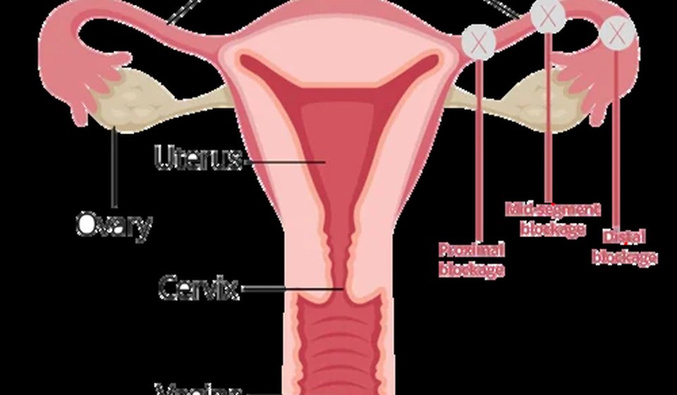 Tubal Factor Infertility at MOMZY Women and Fertility Centre